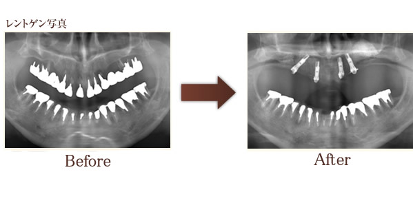 治療例レントゲン写真